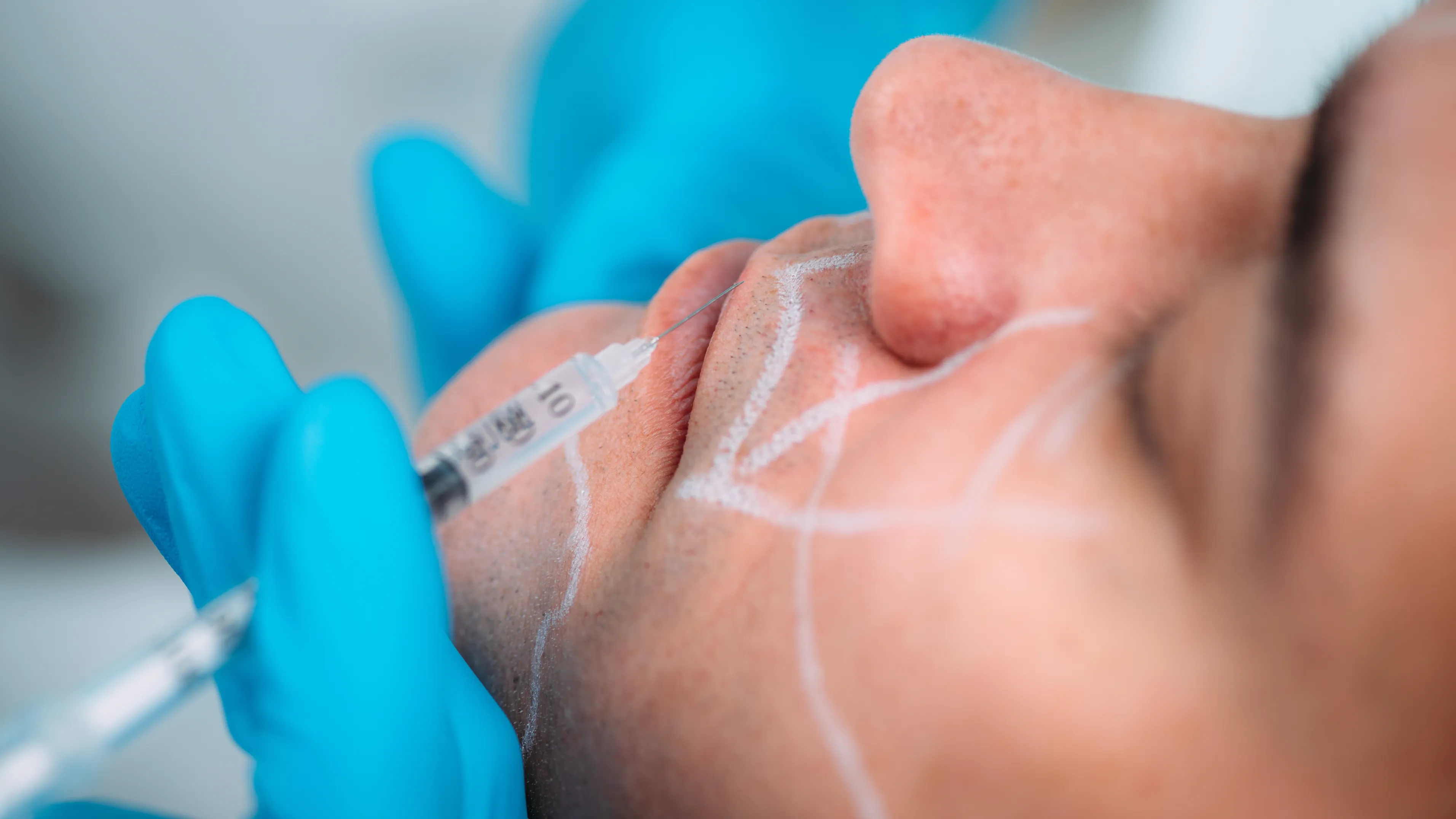 Botox para bruxismo